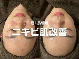 【人気No.1🥇】オーダーメイド肌質改善🌿【肌タイプに合わせたオーダーメイド施術💎💎フルオプション込み価格】