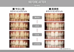 美容ホワイトニング🦷✨10分照射✕3回