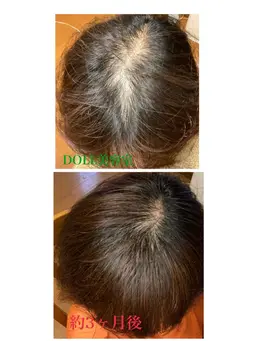 女性のための育毛カウンセリングコース