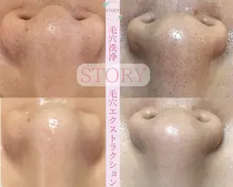 【プレオープン価格⭐︎本気の毛穴ケア】鼻毛穴エクストラクション+ツヤ肌WAX ¥18800→¥11300