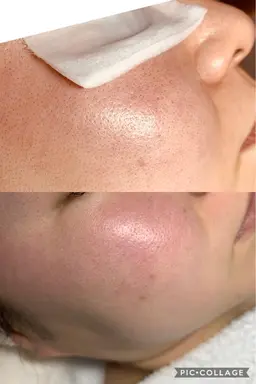 エステダム  イドラディフェンス🐚刺激に負けないお肌へと導きながら、リンパポンパージュ手技で小顔&リフトを目指します。