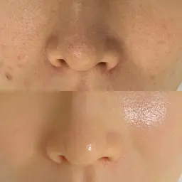 韓国式3D毛穴洗浄✖️ララピール【剥離なしでつるん肌✨】話題のララピール🌿透明感×毛穴レス×陶器肌 ¥13,800