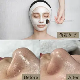《2番人気》【黒ずみ毛穴ケア＆角質ケア】 ピーリングでツヤ肌確定♫ダウンタイムなし◎150分18800円／メンズにも◎