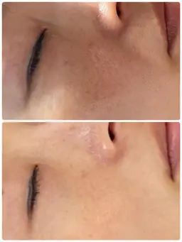 ㊗️🫧目指すは韓国美肌💆‍♀️🫧毛穴洗浄＋イオン導入🫧夏で疲れたお肌に今！潤いをしっかりプルプル肌へ