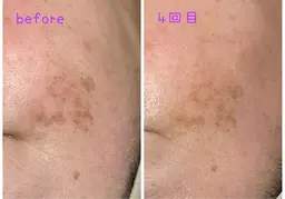 IPL光フェイシャル