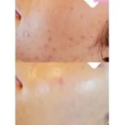 話題の乳酸ピーリング💄