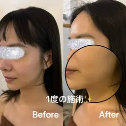 【敏感肌用】韓国美肌(90分)ﾀﾞｳﾝﾀｲﾑ無💫戸田市内で当店だけ取り扱い⭐️ﾏｲｸﾛﾆｰﾄﾞﾙの力で肌周期を3日に！