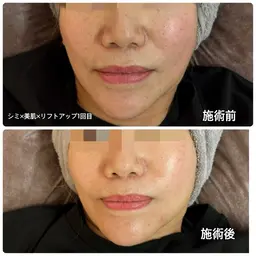 リフトアップコース✨