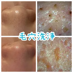 本気で肌を綺麗にしたい！そんな方にオススメ毛穴洗浄‼️✨️