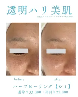 【シミくすみ必見】高級ハーブピーリング&IPL照射