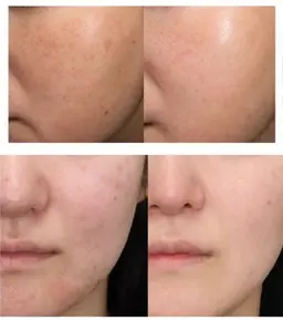 グルタチオン100%原液導入