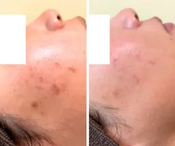 【ハーブピーリング】剥離なし