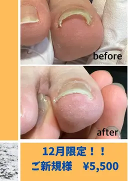 🎅12月ご新規様限定🎄 全巻き爪補正 ¥5,500