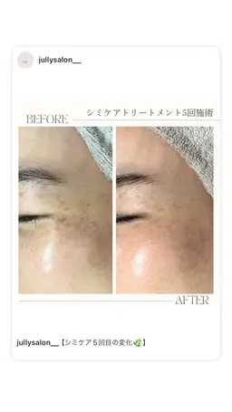 🌻8月限定🌻【毛穴洗浄×シミケア30分】痛くない低周波シミケア‼️
