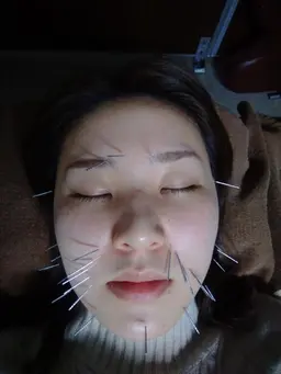 美顔鍼