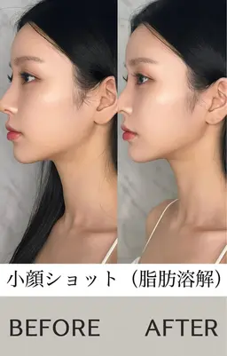 【二重顎を解消◎速攻小顔】脂肪に直接アプローチ!痛みなしでスッキリ小顔へ。リフトアップ効果も◎最新の小顔施術です!