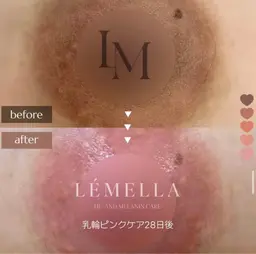 メラニンケア乳輪¥80,000