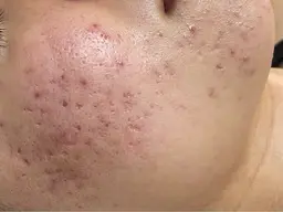 【毛穴・ニキビ】塗るリジュラン導入