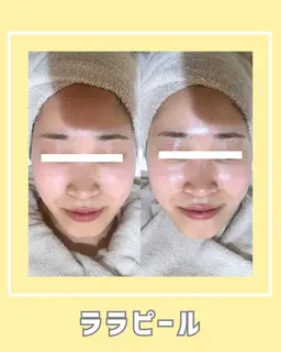 人気NO.2🤍〈韓国肌管理〉ララピール　(剥離&ダウンタイムなし) 60分5,000円