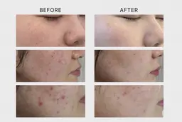 韓国式ハープピーリング