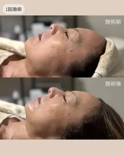 艶肌爆誕!ラミネーションピール🪞✨️