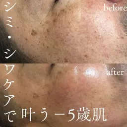 【ノーファンデツヤ肌】ハーブトリートメント(キメを整え驚きのツヤ肌に！)※毛穴ケアオプション込