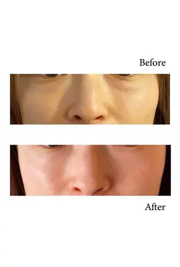 サーマトリックス！一部位（6パーツよりお選びいただけます💁‍♀️）目元の膨らみ、ニキビ跡、もたつき改善