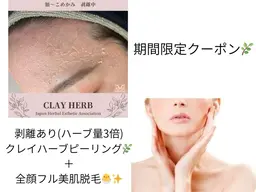 【9月限定】顔脱毛＋剥離ありクレイハーブピーリング　30,000円→26,000円