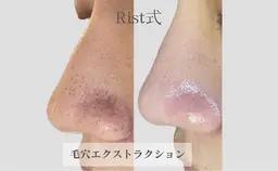 毛穴エクストラクションpetit