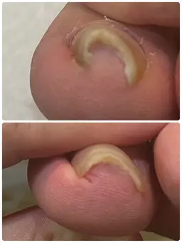 巻き爪矯正カウンセリング