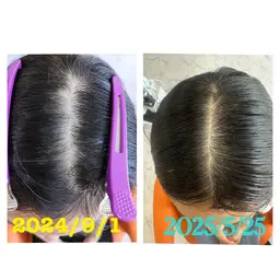 初回体験コース:ファインバブルで頭皮洗浄+プラズマ機械で頭皮余分の皮脂除去+炭酸ミストで血流促進+毛根+毛の密度観察