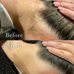 全身脱毛
