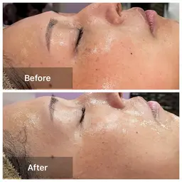 初めての方限定💆♀️モニター価格💎美肌実感ハーブピーリング+鎮静パック付