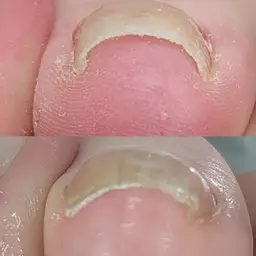 巻き爪中度