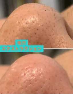 ✨毛穴洗浄✨　　　　　　　　　　　　　　　　　　　tete式毛穴エクストラクション