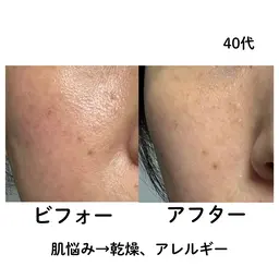 【期間限定‼️】うるおいチャージ＆美肌菌フェイシャル（６０分）