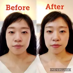 小顔矯正
