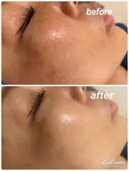 毛穴洗浄エステ