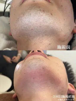 メンズヒゲ脱毛