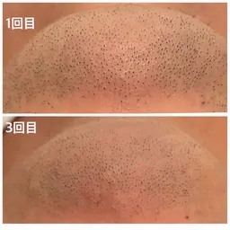 メンズ髭脱毛