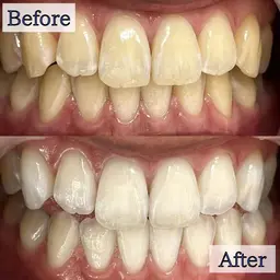 【先着‼️100名様限定👑】セルフホワイトニングハイパワー5分照射🦷定額プラン💎