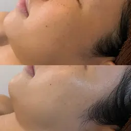 💆🏼‍♀️毛穴ケアフェイシャル30分(光ﾌｫﾄ＋ﾊﾟｯｸ) ¥2200