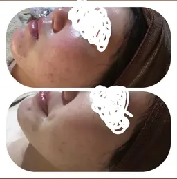 【女性限定】肌荒れをつるつる肌へお顔ゴマージュ
