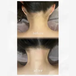 人気メニュー♪アップにする方必見☺️自分じゃ出来ないうなじ脱毛🌟こちらでシェービング致します!3回コース7700円!