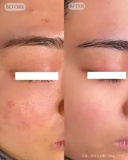 【毛穴・ニキビケア】-毛穴引き締めとお肌に優しいハーブピーリングで健康的な艶肌に🌿剥離せず、ダウンタイムもありません