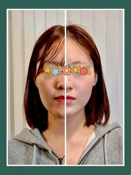 《モニター体験》するすると小顔になる美容鍼