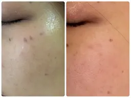 『シミ取り』フェイシャル　老け見えの原因のシミを低周波ペンシルで取り除きます