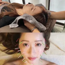 【月・水曜日限定】美容鍼+小顔整体💆🏻♀️小顔に特化メニュー💆🏻♀️