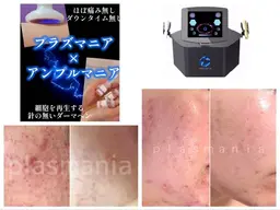 気になる1カ所をプラズマでアプローチ‼️