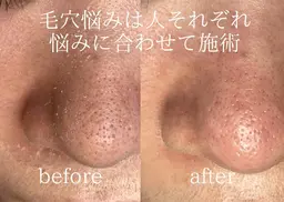 【脱！いちご鼻】毛穴エクストラクション(角栓除去)